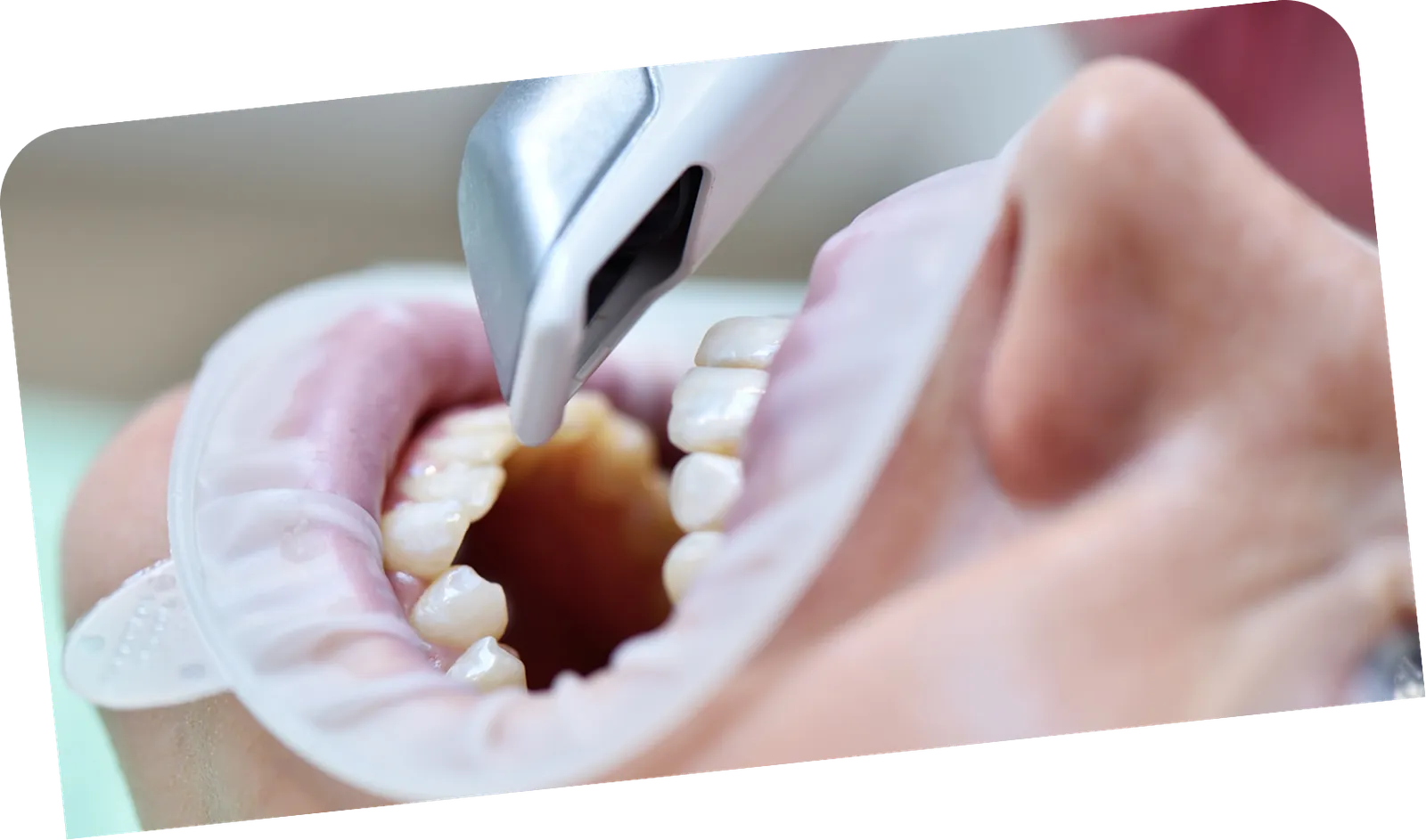 Smile simulation