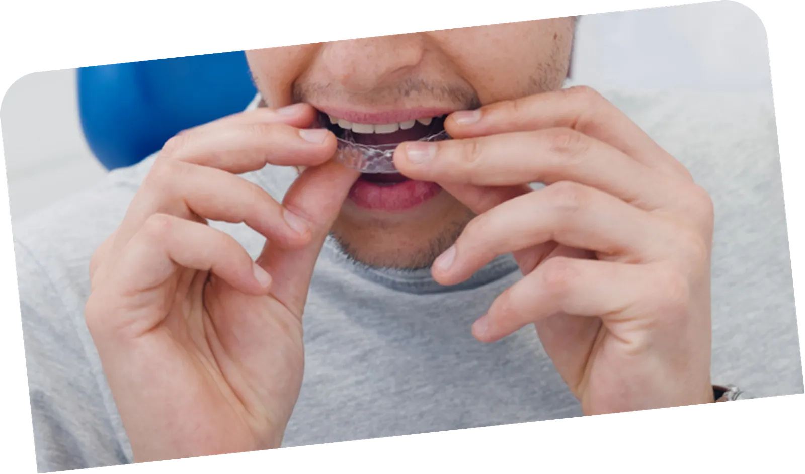 Aligners delivery
