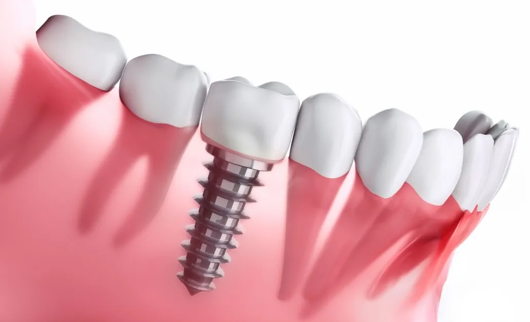 Dental implant close-up