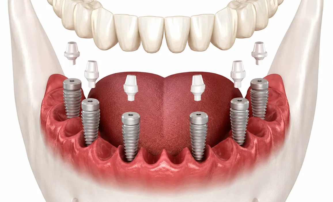 Smile makeover clean white teeth