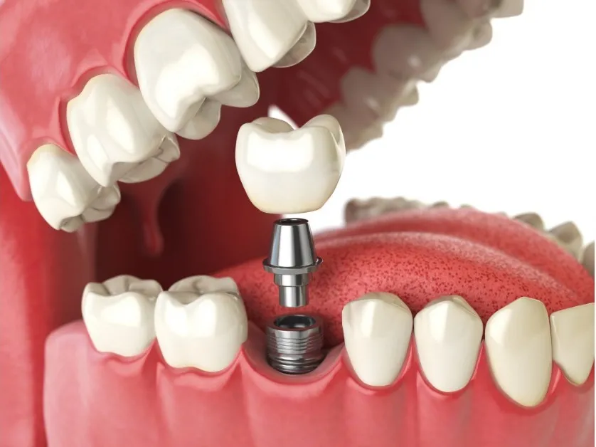 Dental implant crown placement