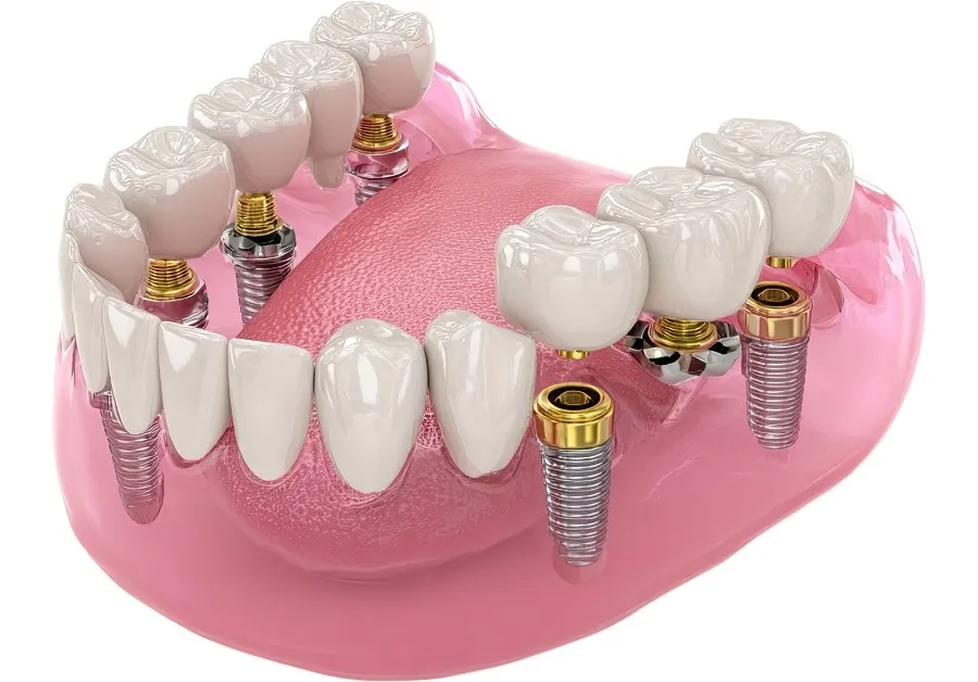 All-on dental implants bridge