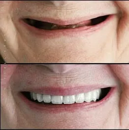 Before and after smile transformation 1