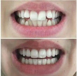 Before and after smile transformation 2