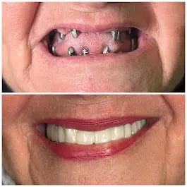 Before and after smile transformation 3