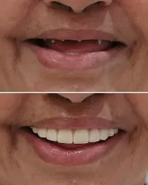 Before and after smile transformation 4