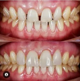 Before and after smile transformation 5