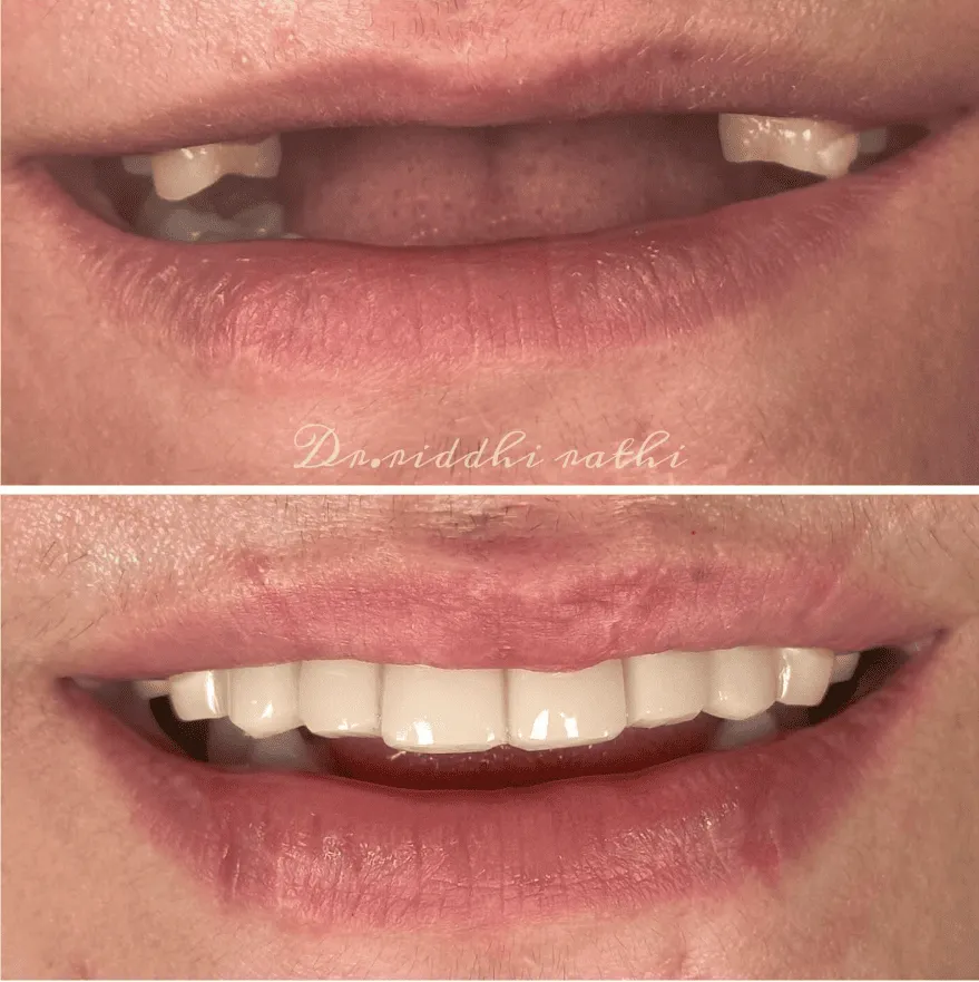 Before and after smile transformation 6
