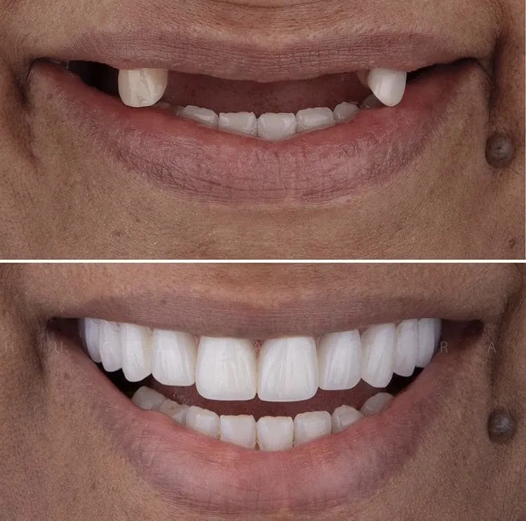 Before and after smile transformation 7
