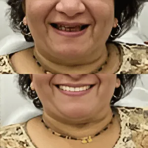Full mouth rehabilitation before and after transformation