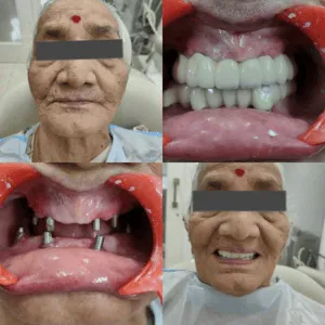 Full mouth rehabilitation before and after transformation
