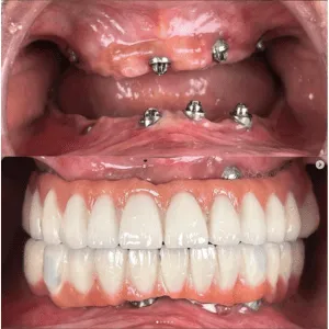 Full mouth rehabilitation before and after transformation