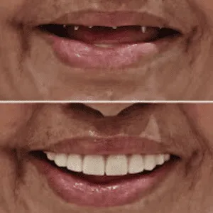 Full mouth rehabilitation before and after transformation