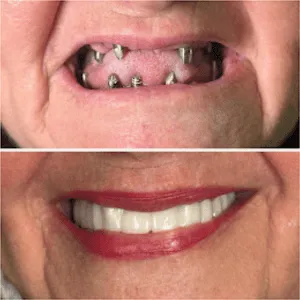 Full mouth rehabilitation before and after transformation