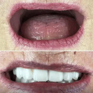Full mouth rehabilitation before and after transformation