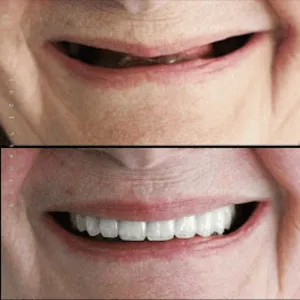 Full mouth rehabilitation before and after transformation