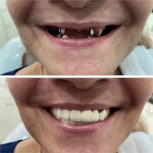 Full mouth rehabilitation before and after transformation