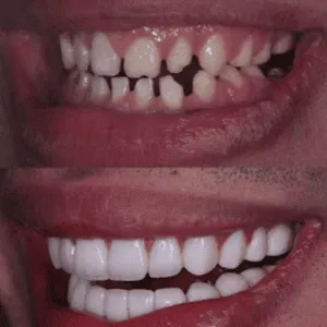 Full mouth rehabilitation before and after transformation