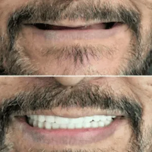 Full mouth rehabilitation before and after transformation