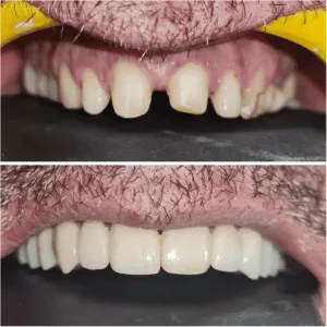 Full mouth rehabilitation before and after transformation