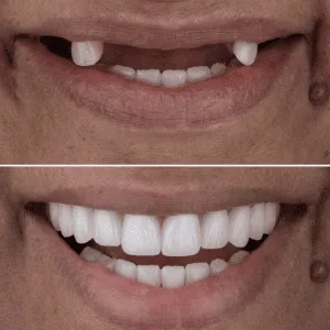 Full mouth rehabilitation before and after transformation