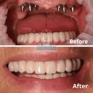 Full mouth rehabilitation before and after transformation