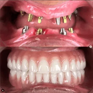 Full mouth rehabilitation before and after transformation