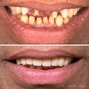 Full mouth rehabilitation before and after transformation