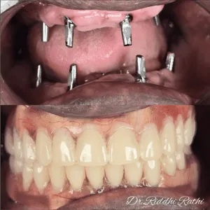 Full mouth rehabilitation before and after transformation