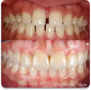 Kids dentistry before and after transformation