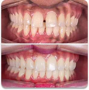 Kids dentistry before and after transformation