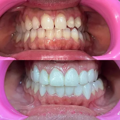 Teeth whitening before and after transformation