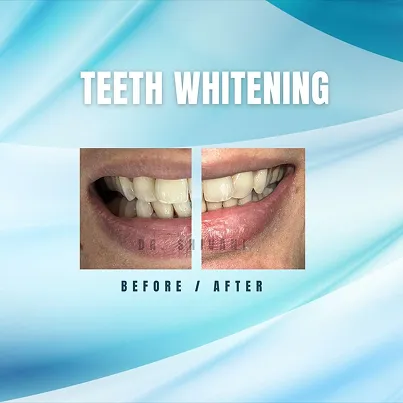Teeth whitening before and after transformation