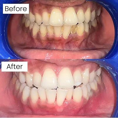 Teeth whitening before and after transformation
