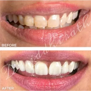 Teeth whitening before and after transformation