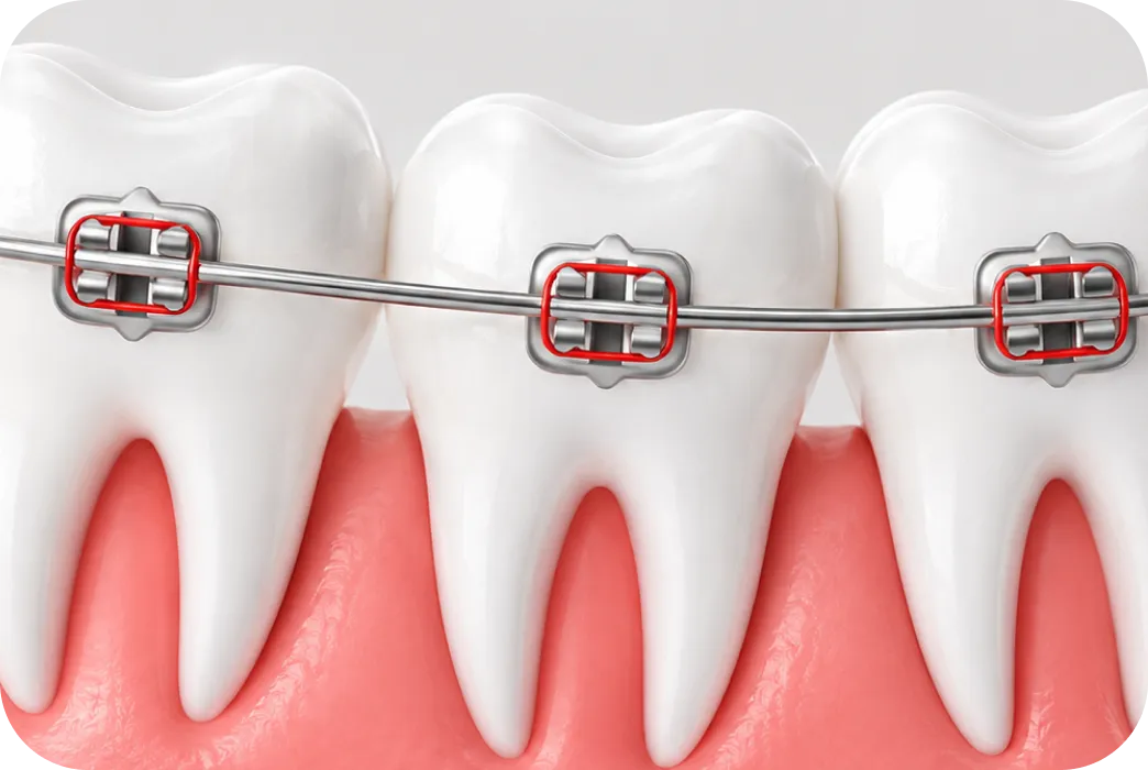 Braces on teeth illustration
