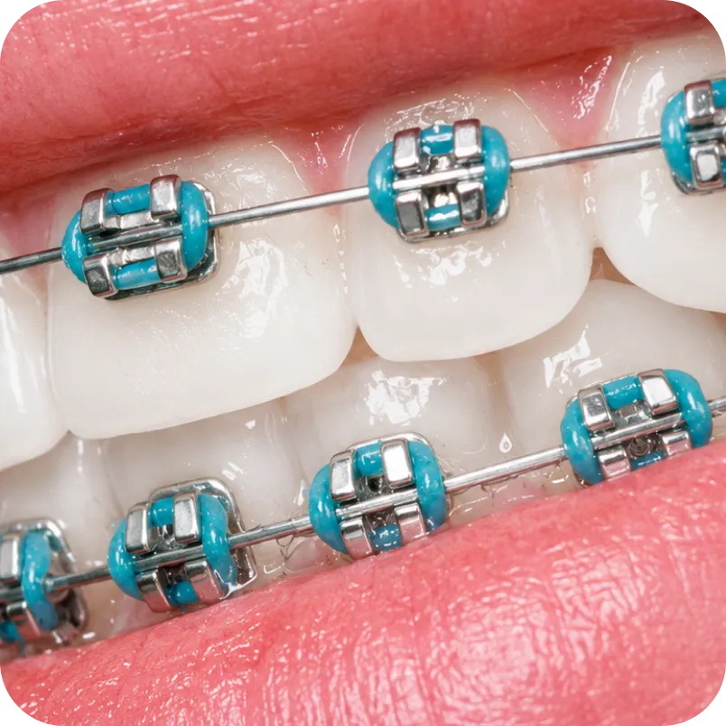 Close-up of braces with coloured elastics