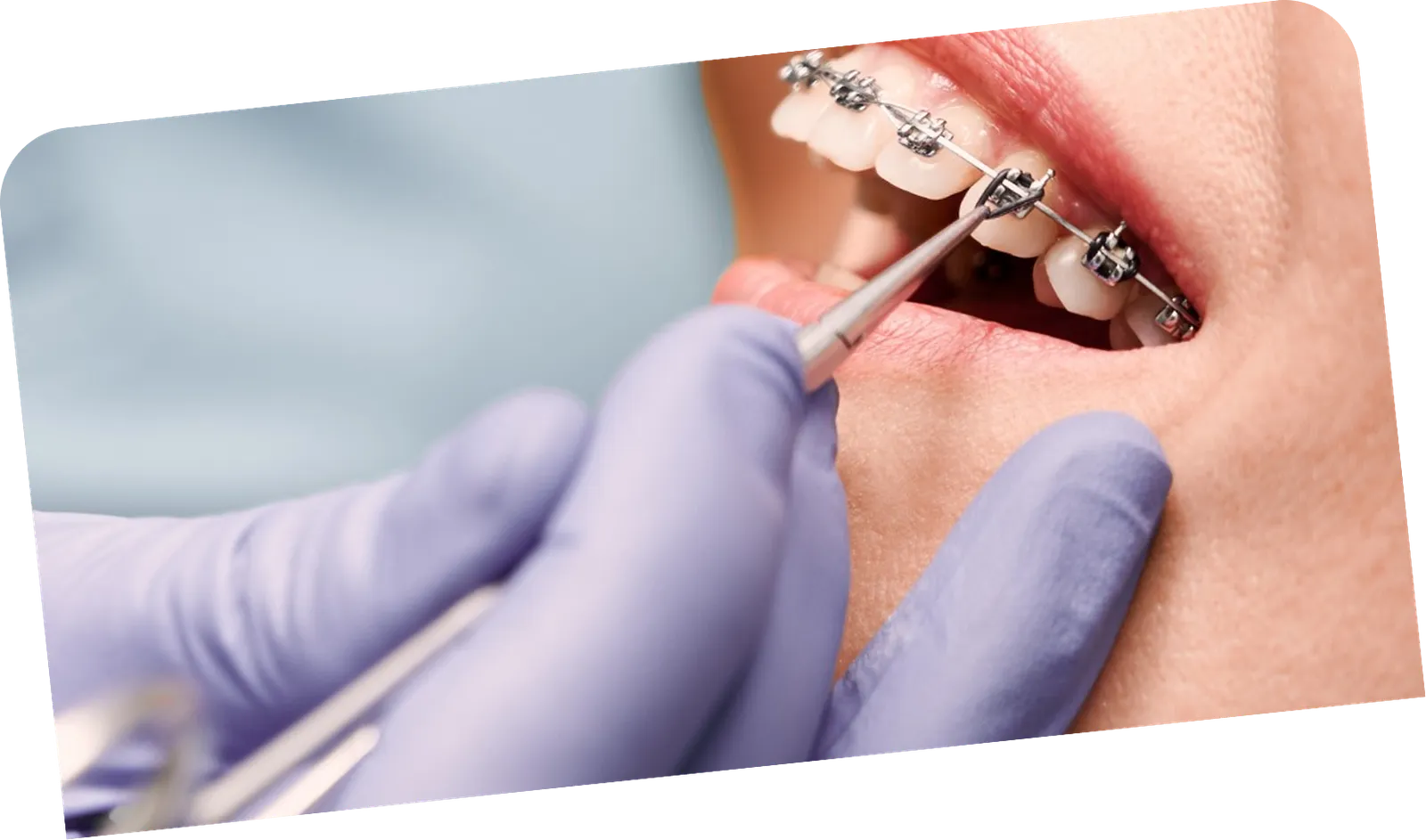 Braces placement