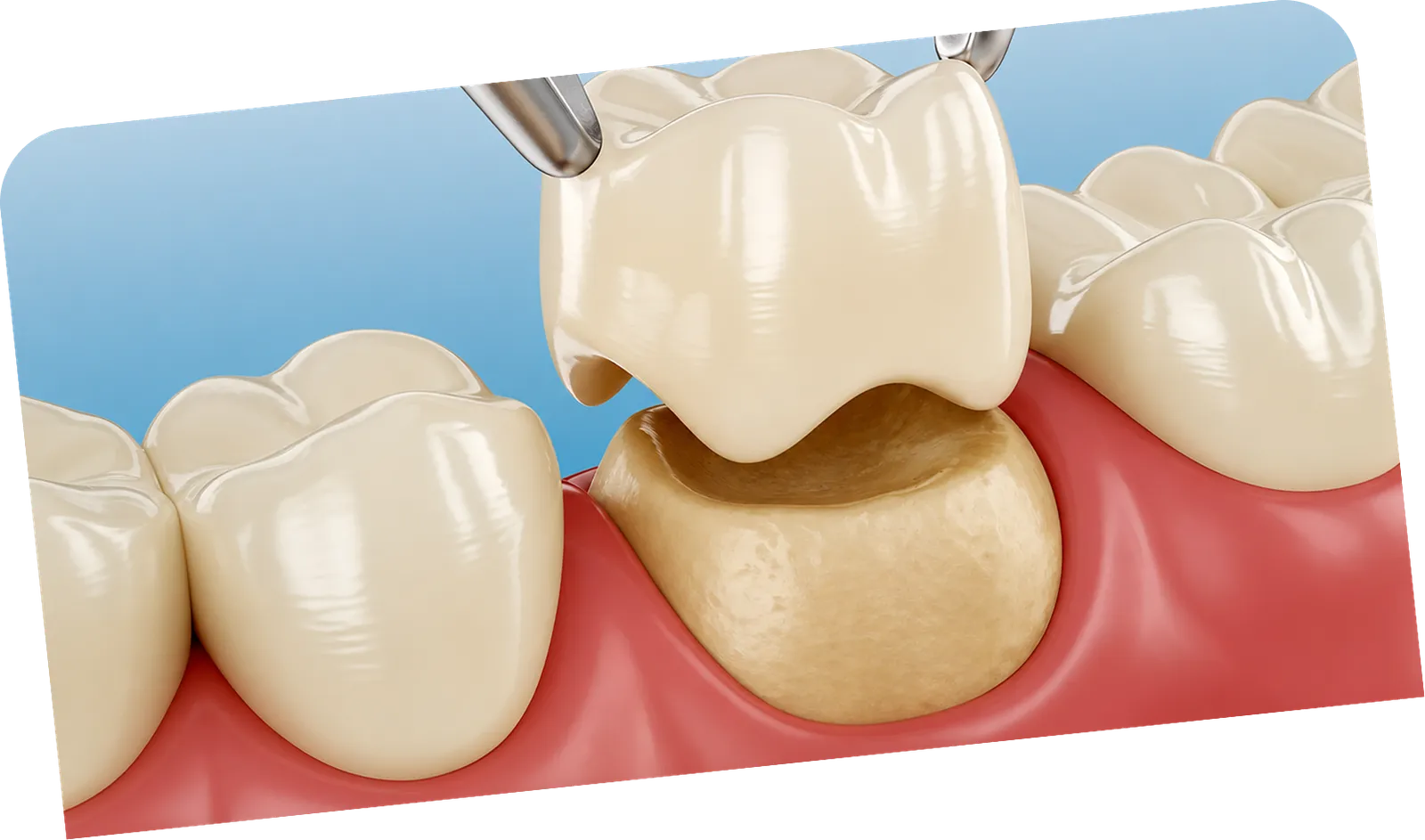 Zirconium crowns