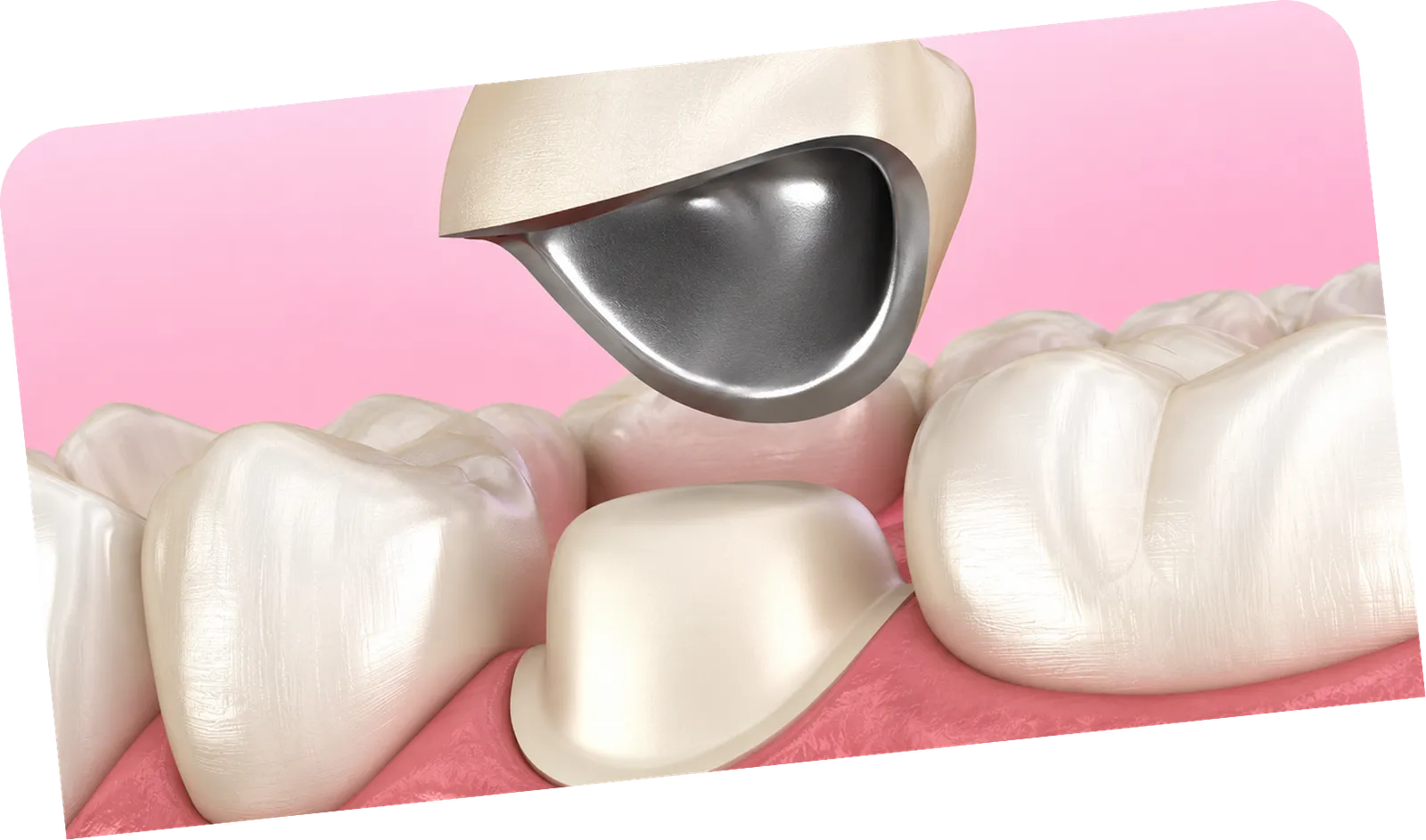 PFM crowns
