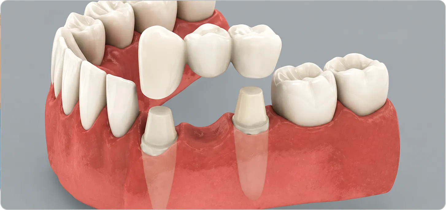 Prevents future dental issues