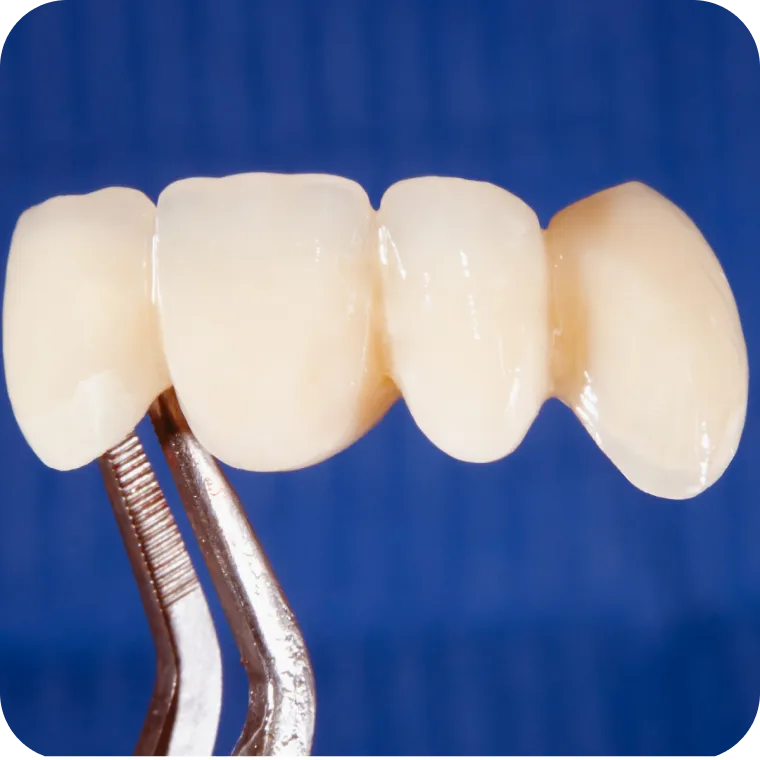 Porcelain dental crown