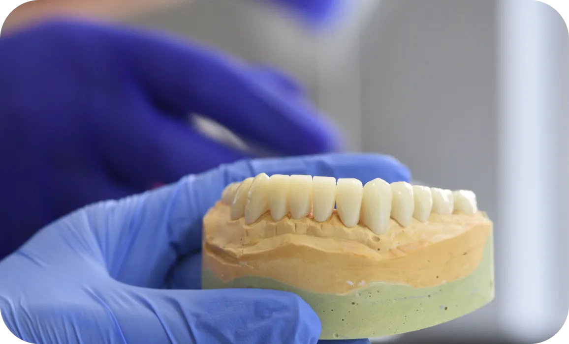 Dental bridge on a model