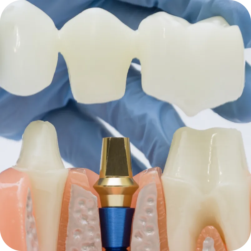 Implant-supported crown and bridge