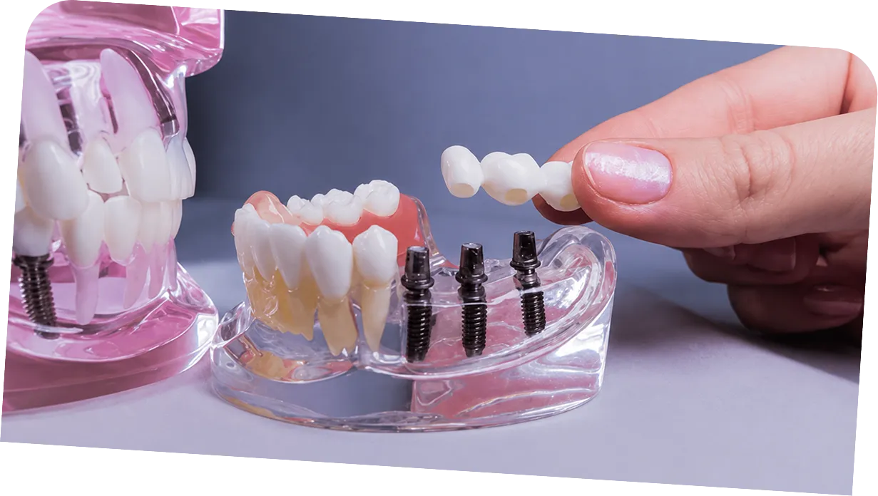 Implants and bridges