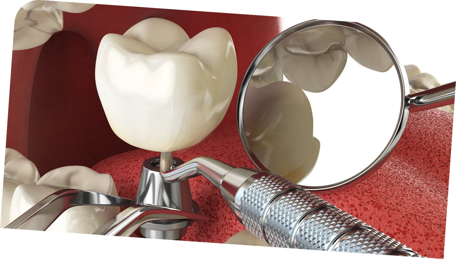 Full mouth dental implants
