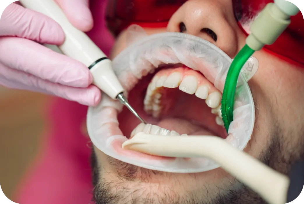 Smile makeover clean white teeth
