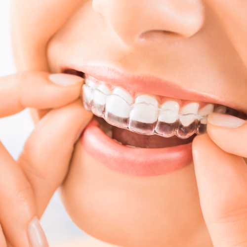 Invisible Aligners