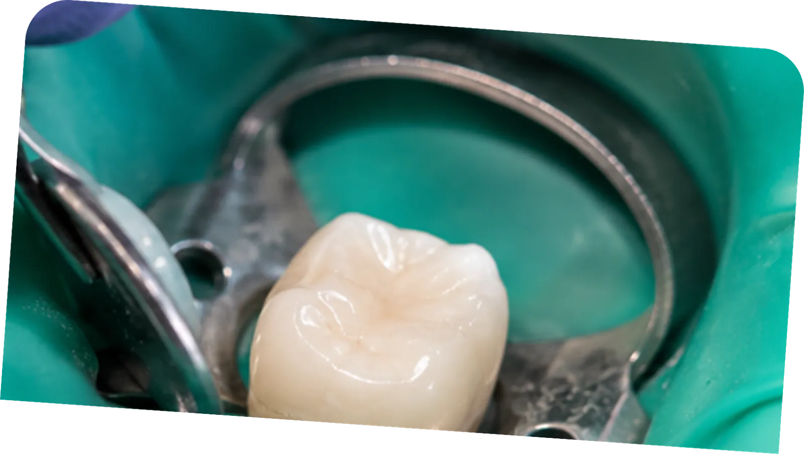 Filling, sealing and final restoration