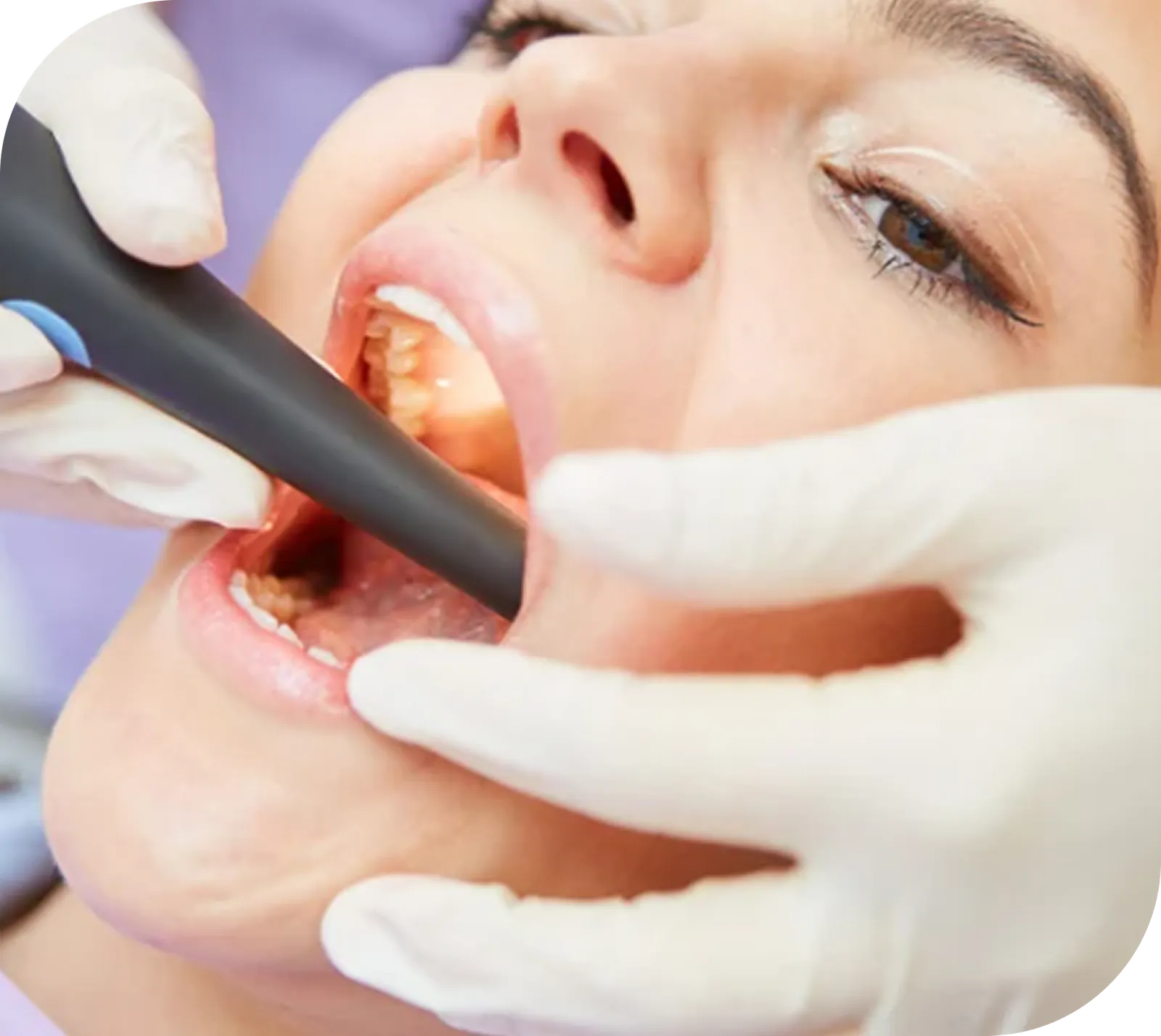 Root Canal Therapy Before and After